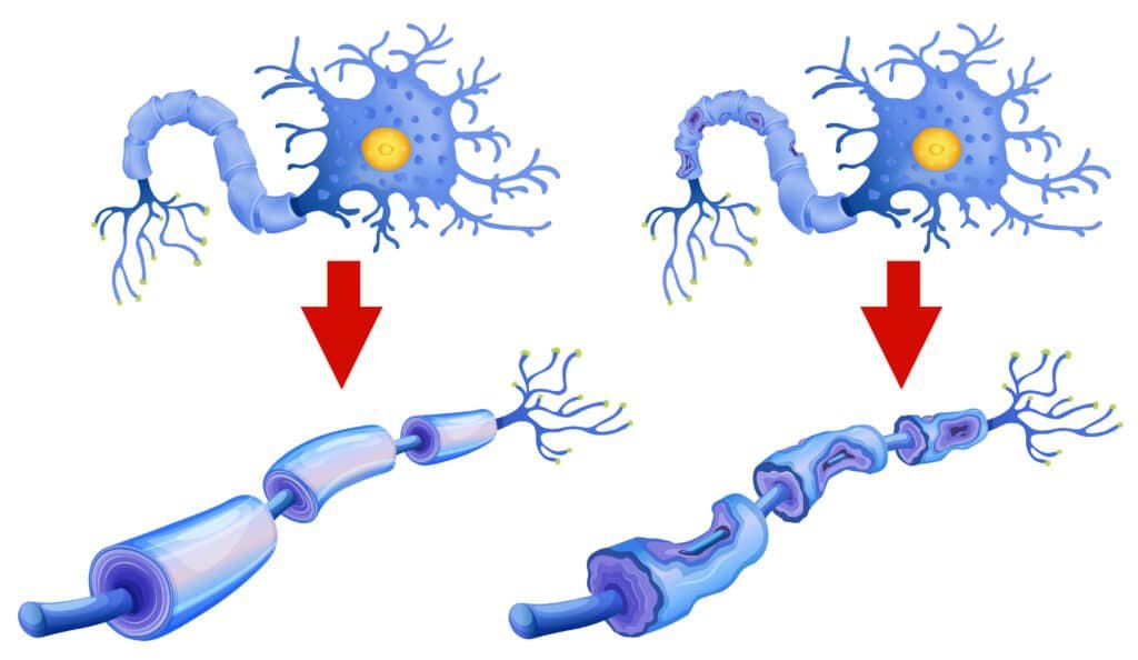 Σκλήρυνση κατά πλάκας κατά την διάρκεια της εγκυμοσύνης