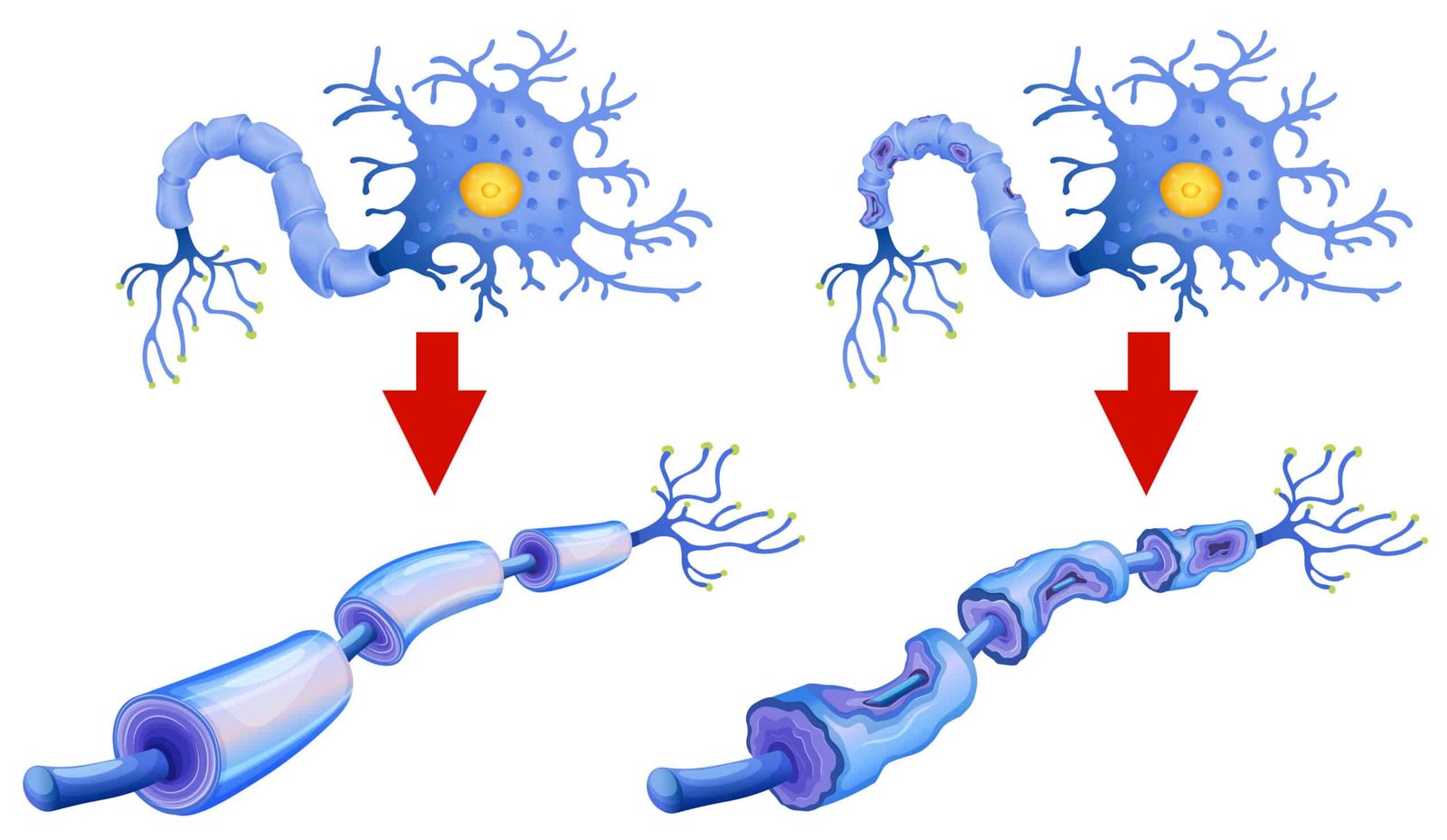 Σκλήρυνση κατά πλάκας κατά την διάρκεια της εγκυμοσύνης