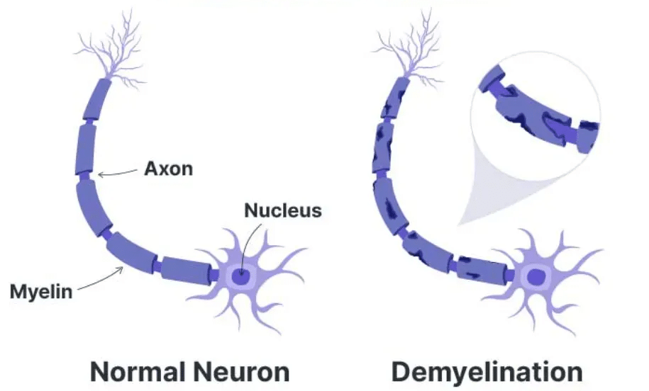 Σύγχρονη θεραπευτική αντιμετώπιση της σκλήρυνσης κατά πλάκας